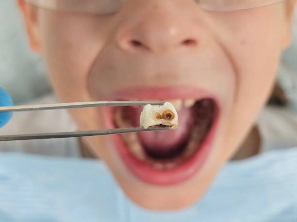 Best Emergency Treatment for Dental Infections or Abscesses in Palos Hls, IL